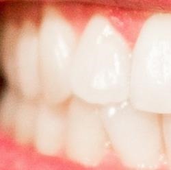 牙结石怎么去除,如何预防牙结石